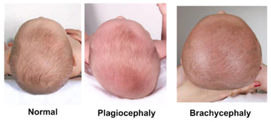 Understanding and Preventing Flat Head Syndrome in Infants